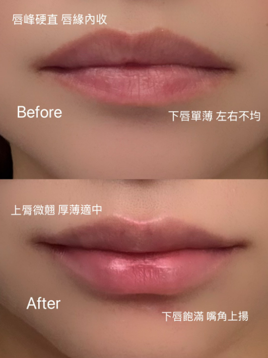 OBT女神動態玻尿酸調整後_嘴唇Bofore/After